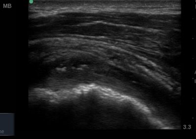 Hill Sachs deformity of the posterior aspect of the humeral head