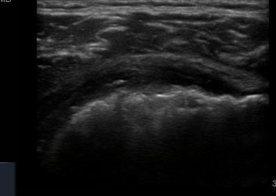 Hill Sachs deformity of the posterior aspect of the humeral head