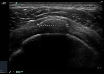 Short axis view of Supraspinatus, demonstrating a region of calcification