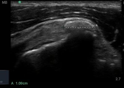Long axis view of Susbcapualris tendon and region of calcification