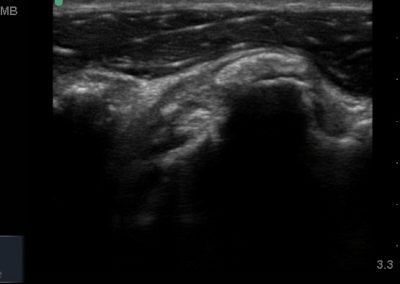 Long axis view of Susbcapualris tendon and region of calcification