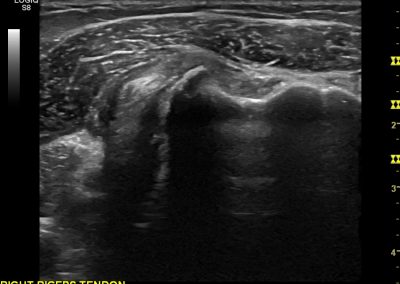 Medially dislocated long head of biceps tendon