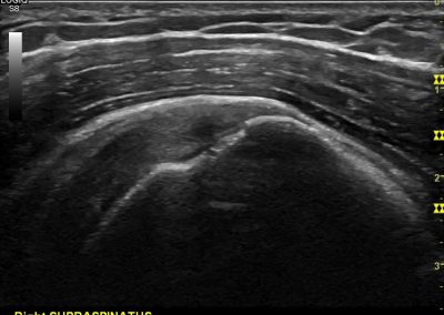 Partial thickness rotator cuff tear: A summary