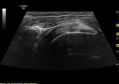 ong axis view of Subscapualris with a medially dislocated long head of biceps