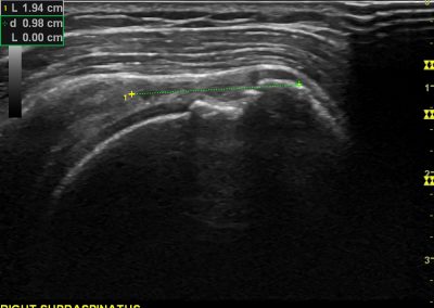 Long axis view of Supraspinatus tear, often present if LHB dislocated