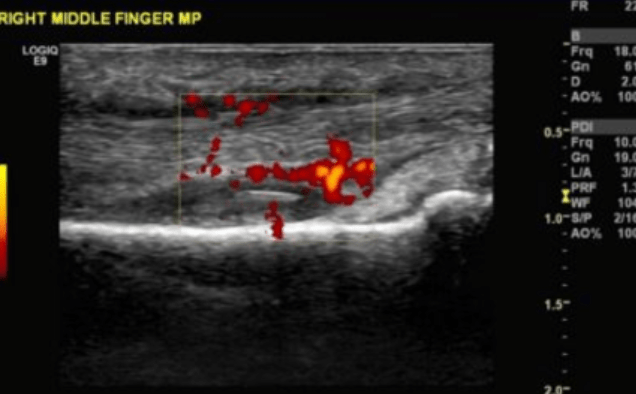 Finger flexor tenosynovitis?