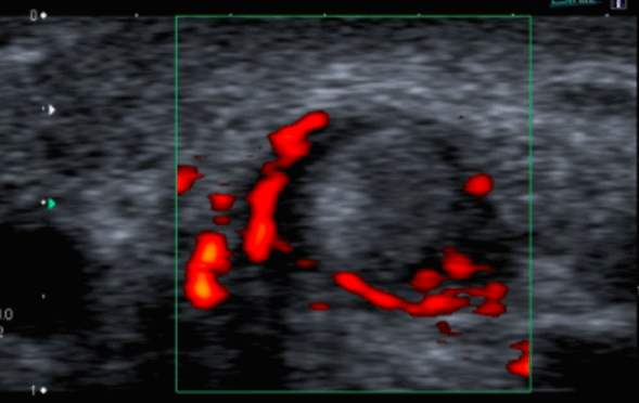 Two cases of De Quervain’s Tenosynovitis. TSV or not TSV – that is the question?