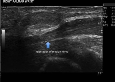 Lipoma compressing the median nerve at the wrist
