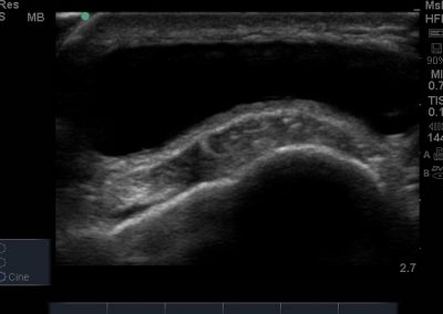 Short axis view of distended and anechoic superficial infrapatellar bursa