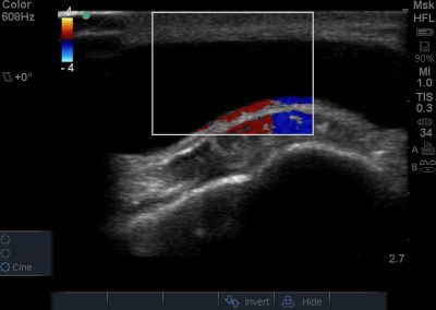 Short axis view of distended and anechoic superficial infrapatellar bursa