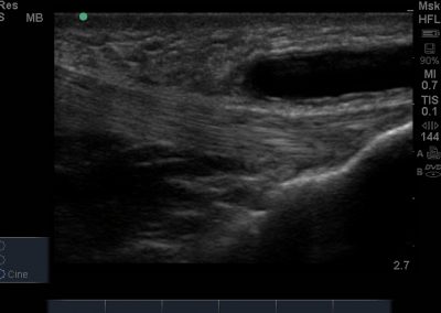 Long axis view of distended and anechoic superficial infrapatellar bursa