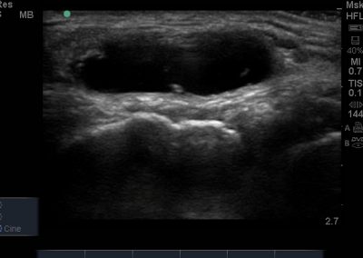 knee ultrasound