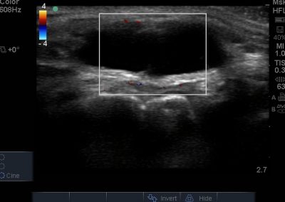 Short axis view of anechoic, not compressible and non vascular superior tibfib joint ganglion