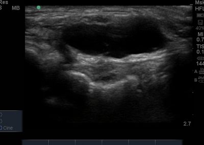 Short axis view of anechoic, not compressible and non vascular superior tibfib joint ganglion. A communication channel can be seen.