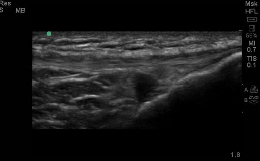 Long axis view of distended deep infrapatellar bursa