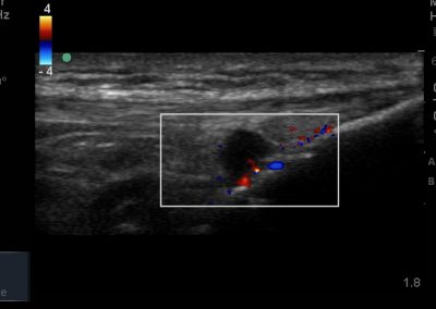 Long axis view of distended deep infrapatellar bursa