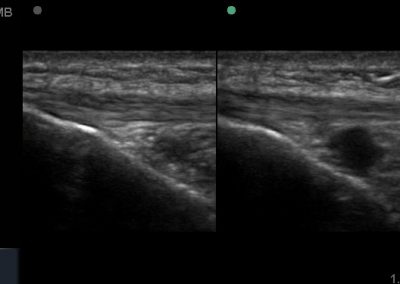 Long axis view of distended deep infrapatellar bursa