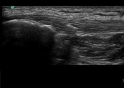 Calcific proximal patella tendinopathy viewed in long axis