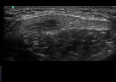 Calcific proximal patella tendinopathy viewed in short axis