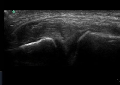 Hypoechoic fissure consistent with a meniscal tear