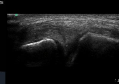 Hypoechoic fissure consistent with a meniscal tear