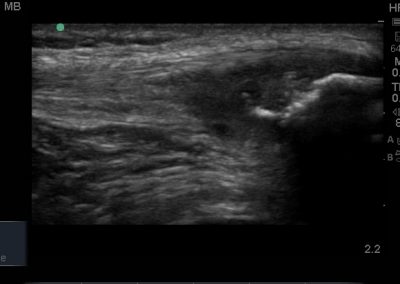 Longitudinal view of the patella tendon and thickened hypoechiic, tendinopathic appearance