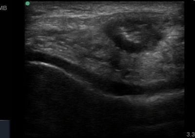 Short view of the patella tendon and thickened hypoechiic, tendinopathic appearance