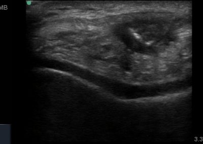 Short view of the patella tendon and thickened hypoechiic, tendinopathic appearance