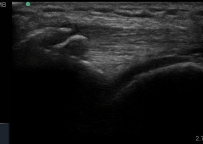 Long axis view of quadriceps tendinopathy