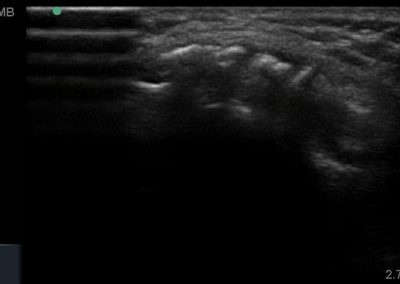 Short axis view of quadriceps tendinopathy