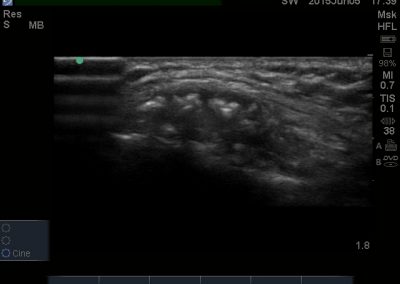 Short axis view of quadriceps calcific tendinopathy