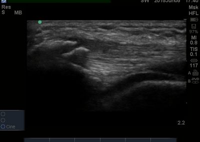 Long axis view of quadriceps tendinopathy