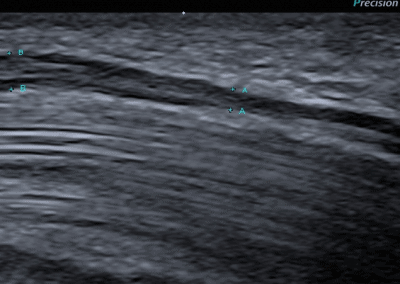 Ultrasound in carpal tunnel syndrome