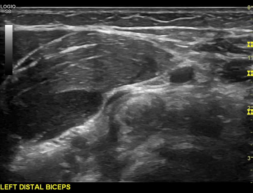 Short axis view of the distal biceps tendon