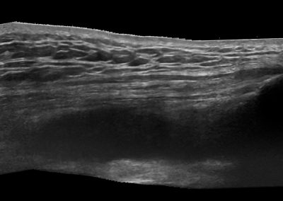 Long axis view of a large anechoic suprapatellar recess knee effusion