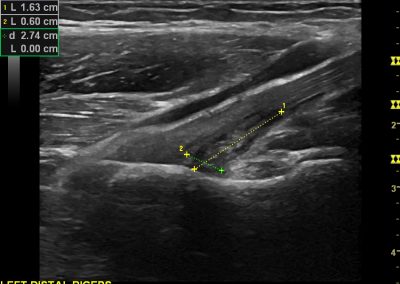 Anterior elbow pain: A case of partial tear of the distal biceps tendon