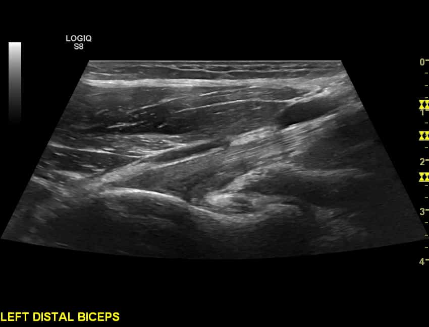 Longitudinal view of distal biceps insertion