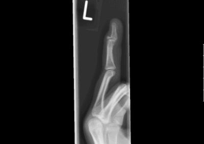There is a non united avulsion fracture of the proximal segment of the distal phalanx, major finger left hand.