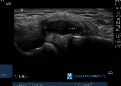Lateral meniscal cyst