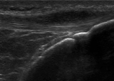 Acute patella tendon impact injury