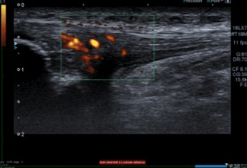 Patella tendinopathy (Jumper's Knee) - Ultrasound Guided Injections