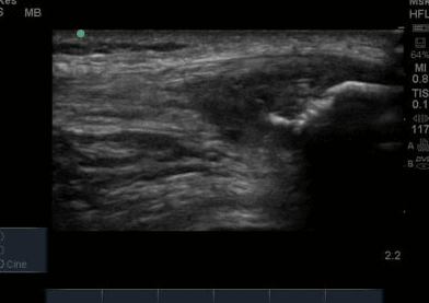 Patellar tendinopathy and diagnostic ultrasound