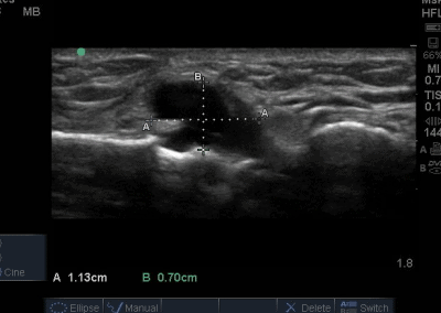 Longitudinal ultrasound view demonstrating anaechoic cystic structure communicating with cortex of the tibia.