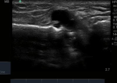 Longitudinal ultrasound view demonstrating anechoic cystic structure communicating with cortex of the tibia