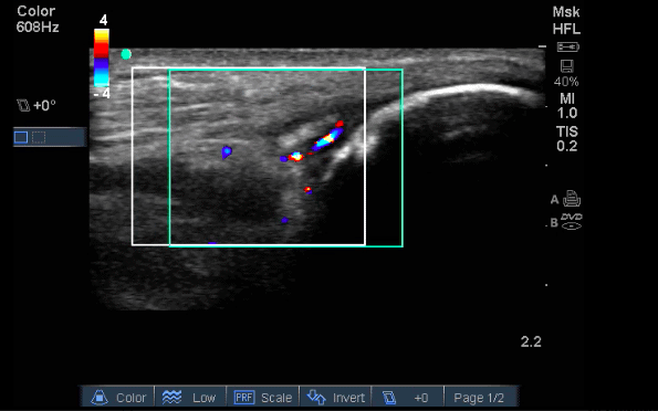 Insertional enthesitis of the triceps