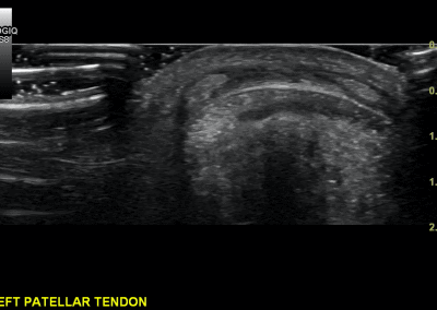 Short axis view of a subtle distension of the pre patella bursa