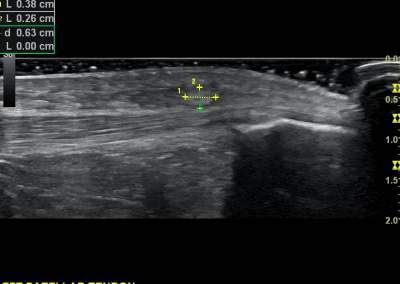 Long axis view of a subtle distension of the pre patella bursa