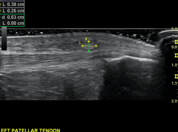 Long axis view of a subtle distension of the pre patella bursa