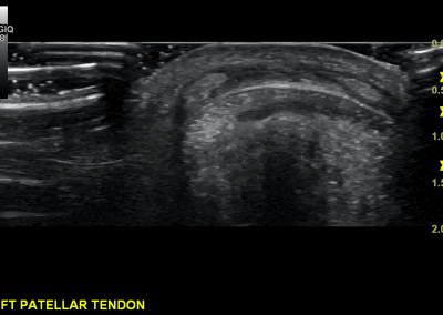 Short axis view of a subtle distension of the pre patella bursa