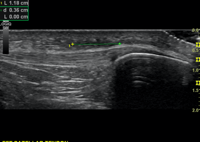 Long axis view of a subtle distension of the pre patella bursa